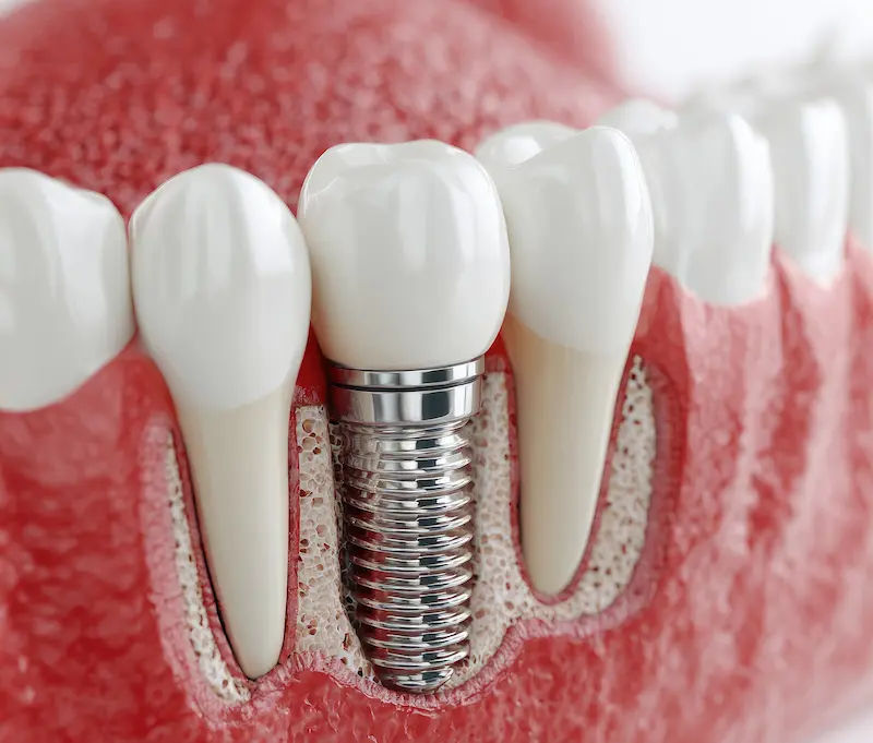 Dental Care Dental Implants for Fixed Teeth—Fast